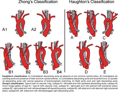 Cervical aortic arch in the pediatric population: a meta-analysis of individual patient's data